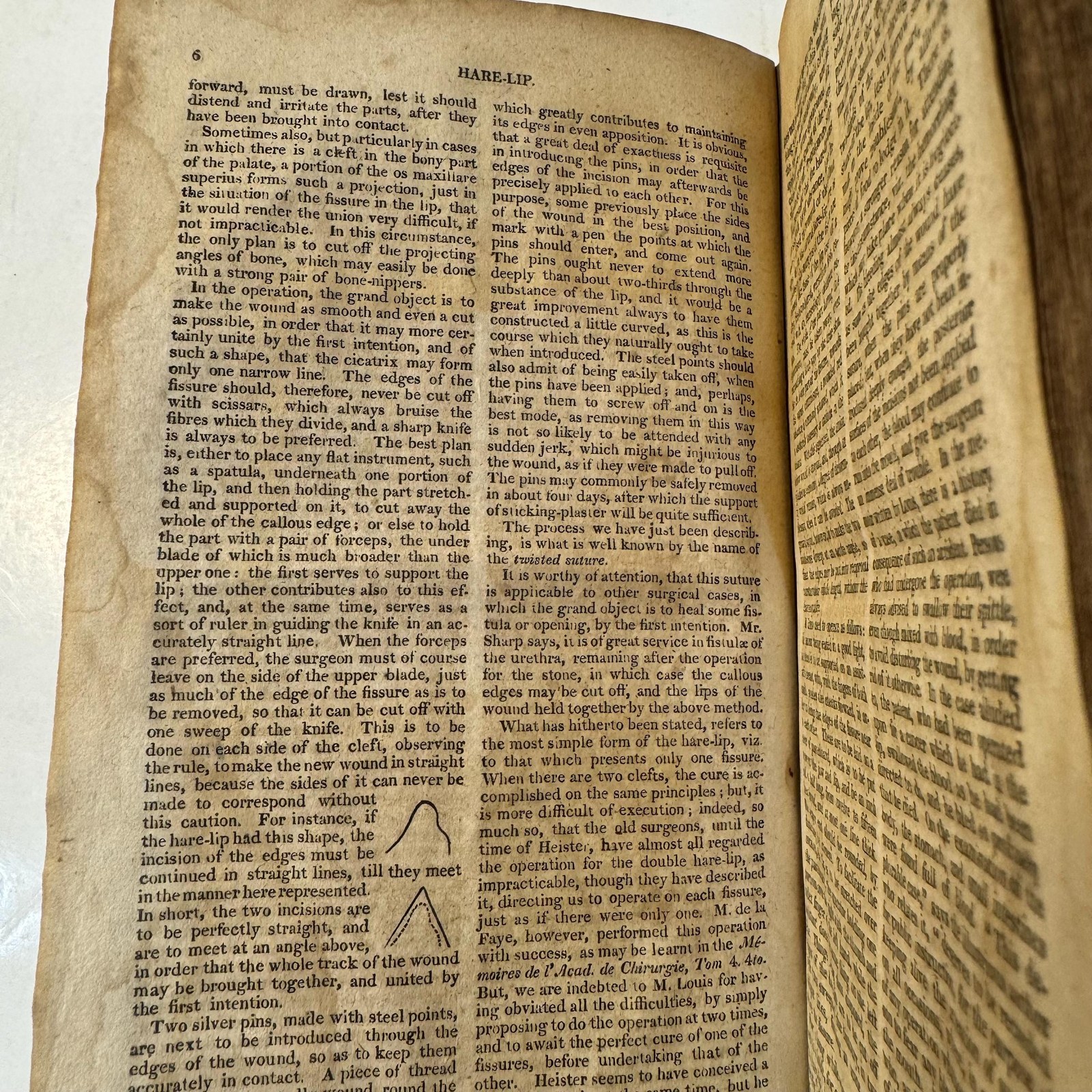 Dictionary of Practical Surgery, containing a complete exhibition of the present state of the principles and practice of Surgery, collected From the best and most original sources of information, and illustrated by critical remarks. — photograph 8.