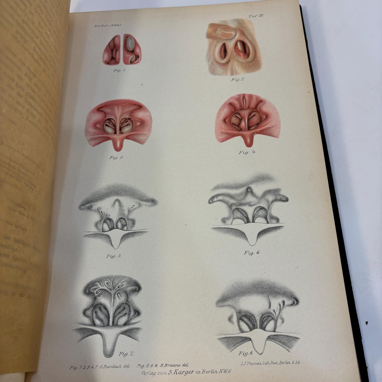Atlas der Krankheiten der Nase, ihrer Nebenhöhlen und des Nasenrachenraumes. 363 Figuren auf 42 Tafeln Mit erläuterndem Text. Von Privatdocent Dr. P. H. Gerber Spezialarzt für Nasen-, Ohren- und Halskrankheiten in Königsberg i. Pr. Korrespondierendes Mitglied der Laryngologischen Gesellschaft zu Berlin und der französischen Gesellschaft für Otologie, Rhinologie und Laryngologie zu Paris. Translated: Atlas of the Diseases of the Nose, Its Accessory Sinuses and the Nasopharyngeal Cavity. 363 Illustrations on 42 Plates With Explanatory Text. By Privatdozent Dr. P. H. Gerber Specialist in Diseases of the Nose, Ears, and Throat in Königsberg, Prussia. Corresponding Member of the Laryngological Society of Berlin and of the French Society for Otology, Rhinology, and Laryngology in Paris. — photograph 9.