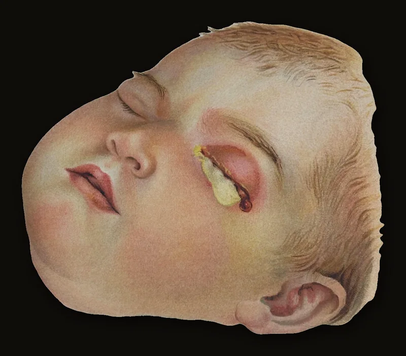 Atlas of the Diseases of the Eye Including a Brief Treatise on The Pathology and Treatment. Authorized Translation from The German. With 76 Colored Plates and 6 Engravings. Saunders' Medical Hand-Atlases..