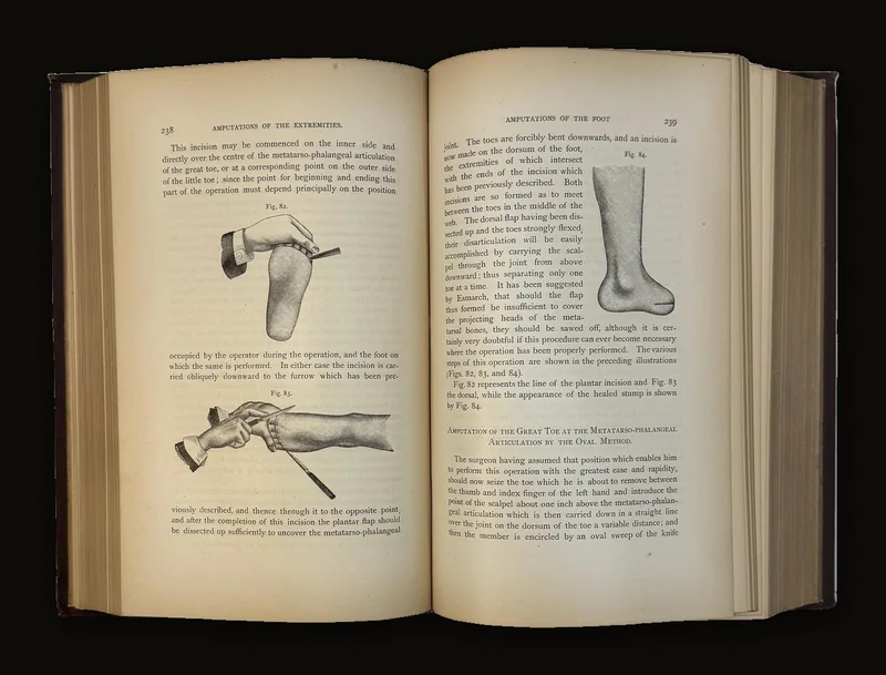 A Treatise on Amputations of The Extremities and Their Complications by Dr. B.A. Watson, 1885 | Illustrated with 250+ Images.