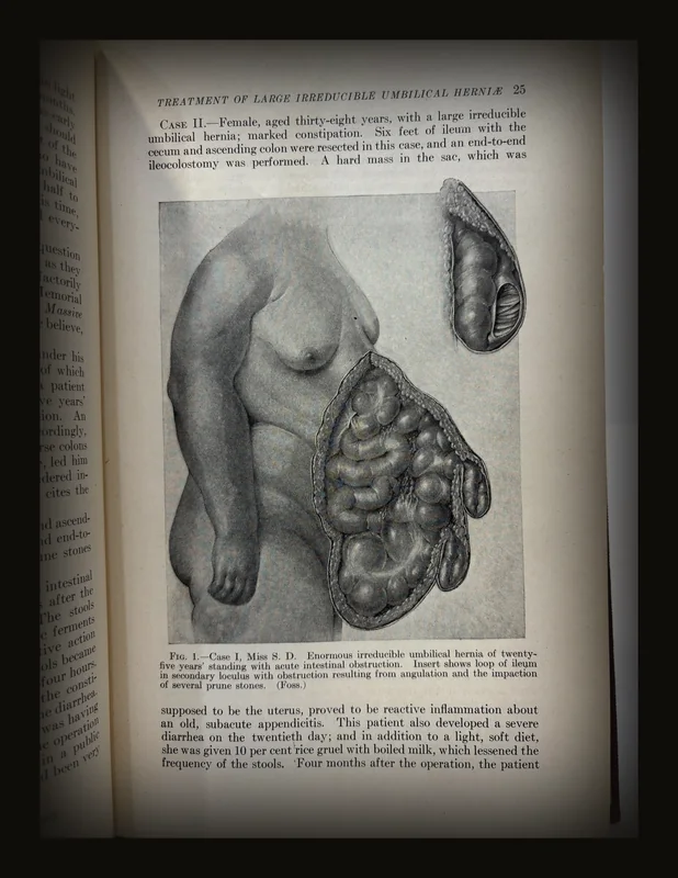 Progressive Medicine, 1923. A Quarterly Digest of Advances, Discoveries and Improvements in The Medical and Surgical Sciences..