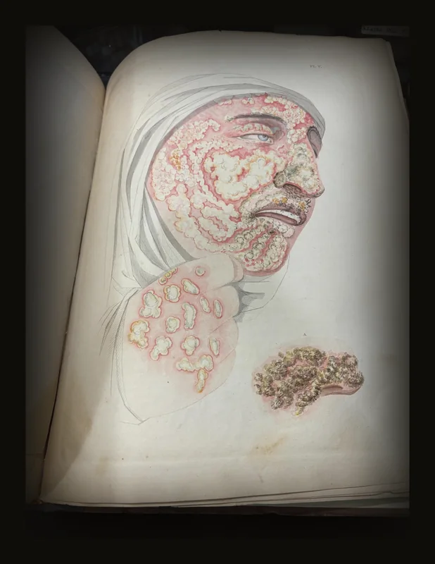 Description of the Distinct, Confluent, and Innoculated Small Pox, Varioloid Disease, Cow Pox, and Chicken Pox.  Illustrated by Thirteen Plates. (thirteen stipple engravings with hand-coloring).